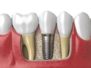 Dental Implants Haverhill MA